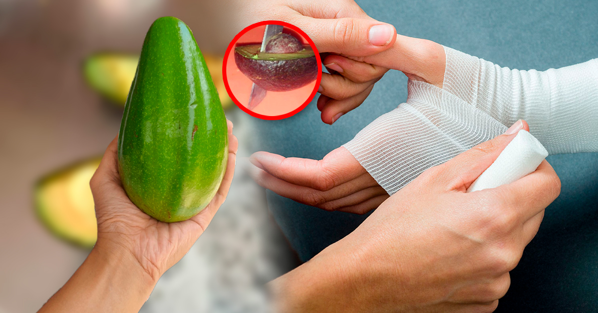 La «mano de palta»: ¿Qué es y por qué un hospital de Alemania advierte del aumento de casos?